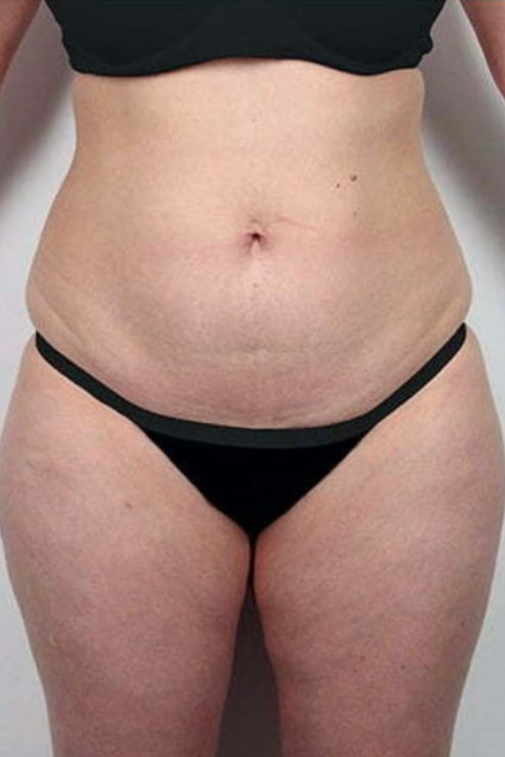 Thigh Contouring - Before