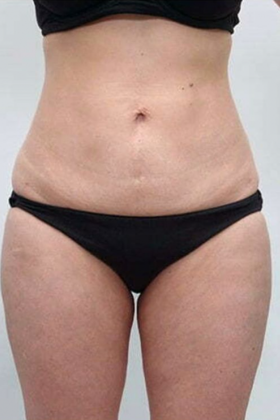Thigh Contouring - After
